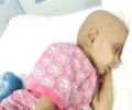 الطبيب المعالج لـ الطفلة "راما": آثار الكيماوي ستزول بعد ثلاثة أشهر